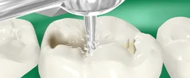 Choosing the Right Type of Teeth Filling | San Francisco Choosing the Right Type of Teeth Filling | San Francisco