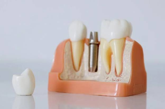 Dental Implants