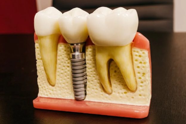 How Many Teeth Can Be Replaced by Dental Implants in San Francisco?