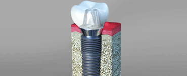 Dental Implants San Francisco, CA