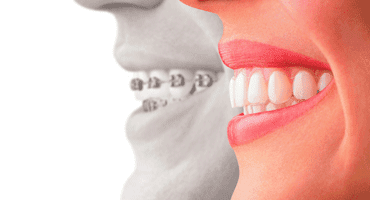 Invisalign vs. Traditional Braces: Making the Right Choice for a Perfect  Smile in Dedham, MA